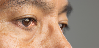 Cataracts: Causes, Symptoms & Treatments