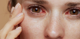 Dry Eyes: Diagnosis, Causes, & Treatments